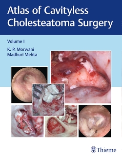 Atlas of Cavityless Cholesteatoma Surgery, Vol 1 von Mehta,  Madhuri, Morwani,  K