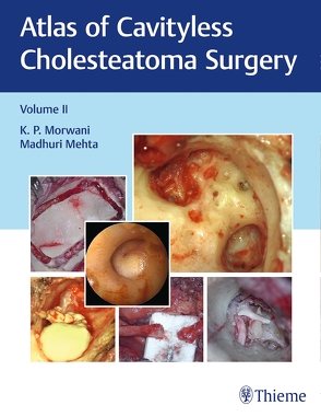 Atlas of Cavityless Cholesteatoma Surgery, Vol 2 von Mehta,  Madhuri, Morwani,  K