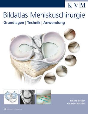 Bildatlas Meniskuschirurgie von Becker,  Roland, Schaller,  Christian