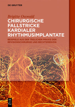 Chirurgische Fallstricke kardialer Rhythmusimplantate von Osswald,  Brigitte