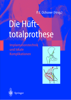 Die Hüfttotalprothese von Ochsner,  Peter E.