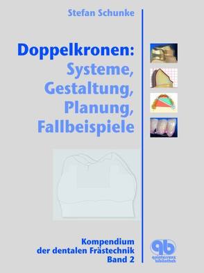 Doppelkronen: Systeme, Gestaltung, Planung, Fallbeispiele von Schunke,  Stephan