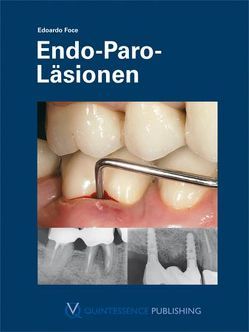 Endo-Paro-Läsionen von Foce,  Edoardo