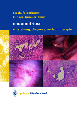 Endometriose von Brucker,  Cosima, Felberbaum,  Ricardo E., Finas,  Dominique F., Küpker,  Wolfgang, Steck,  Thomas