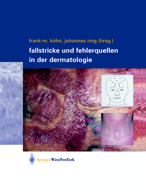 Fallstricke und Fehlerquellen in der Dermatologie von Köhn,  Frank-Michael, Ring,  Johannes