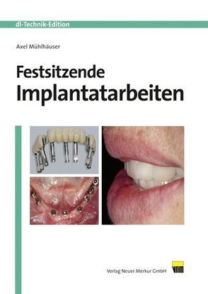 Festsitzende Implantatarbeiten von Mühlhäuser,  Axel