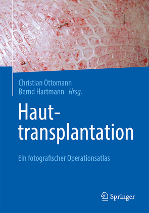 Hauttransplantation von Hartmann,  Bernd, Ottomann,  Christian