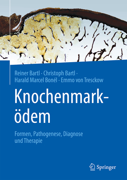 Knochenmarködem von Bartl,  Christoph, Bartl,  Reiner, Bonél,  Harald Marcel, von Tresckow,  Emmo