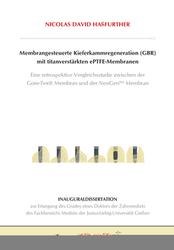 Membrangesteuerte Kieferkammregeneration (GBR) mit titanverstärkten ePTFE-Membranen von Haßfurther,  Nicolas David