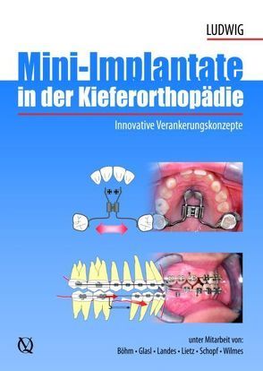 Mini-Implantate in der Kieferorthopädie von Ludwig,  Björn