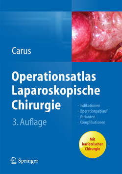 Operationsatlas Laparoskopische Chirurgie von Carus,  Thomas