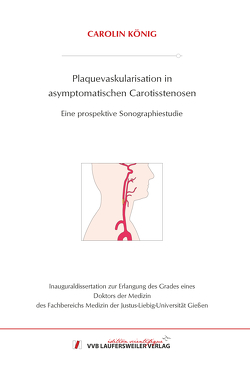 Plaquevaskularisation in asymptomatischen Carotisstenosen von König,  Carolin