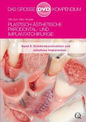 Plastisch-Ästhetische Parodontal- und Implantatchirurgie von Hürzeler,  Marc, Zuhr,  Otto