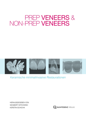 Prep Veneers und Non-Prep Veneers von Schicha,  Kerstin, Witkowski,  Siegbert