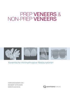 Prep Veneers und Non-Prep Veneers von Schicha,  Kerstin, Witkowski,  Siegbert