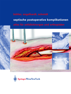 Septische postoperative Komplikationen von Bühler,  Matthias, Engelhardt,  Martin, Schmidt,  Hergo G.K.