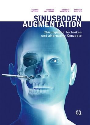 Sinusbodenaugmentation von del Fabbro,  Massimo, Testori,  Tiziano, Wallace,  Stephen, Weinstein,  Roberto