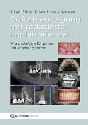 Sofortversorgung mit reduzierter Implantatanzahl von Adler,  Stephan, Bayer,  Georg, Kistler,  Frank, Kistler,  Steffen, Neugebauer,  Jörg, Sigmund,  Fabian, Vizethum,  Freimut, Weiss,  Michael