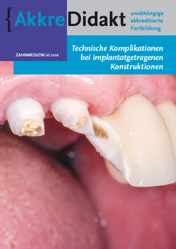 Technische Komplikationen bei implantatgetragenen Konstruktionen von van der Avoort,  Gordon