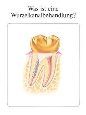 Was ist eine Wurzelkanalbehandlung? von Berns,  Joel M