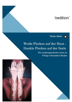 Weiße Flecken auf der Haut – Dunkle Flecken auf der Seele von Albers,  Florian