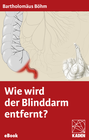 Wie wird der Blinddarm entfernt? von Böhm,  Bartholomäus